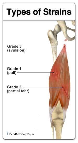 hamstring test for tear|different types of hamstring strains.